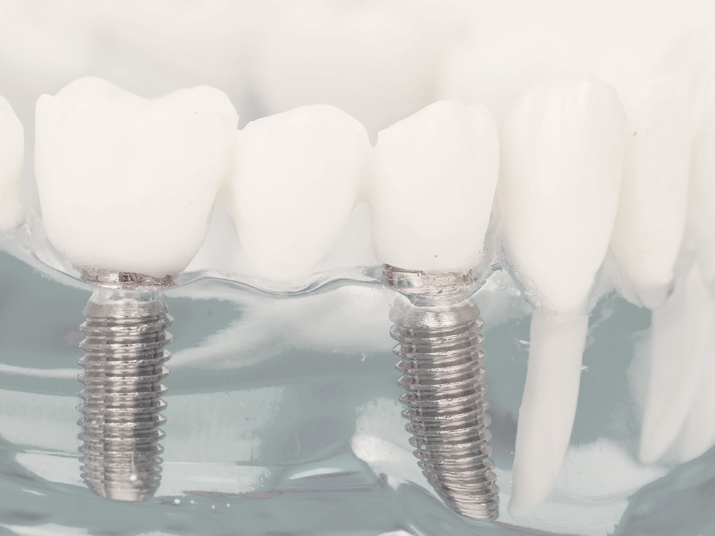 Dental Implant Restorations